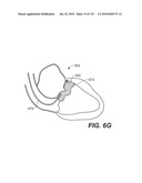 DIAGNOSTIC CATHETERS, GUIDE CATHETERS, VISUALIZATION DEVICES AND CHORD MANIPULATION DEVICES, AND RELATED KITS AND METHODS diagram and image