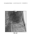 DIAGNOSTIC CATHETERS, GUIDE CATHETERS, VISUALIZATION DEVICES AND CHORD MANIPULATION DEVICES, AND RELATED KITS AND METHODS diagram and image