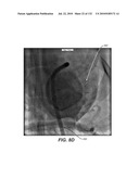 DIAGNOSTIC CATHETERS, GUIDE CATHETERS, VISUALIZATION DEVICES AND CHORD MANIPULATION DEVICES, AND RELATED KITS AND METHODS diagram and image