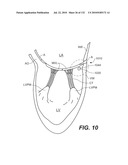 DIAGNOSTIC CATHETERS, GUIDE CATHETERS, VISUALIZATION DEVICES AND CHORD MANIPULATION DEVICES, AND RELATED KITS AND METHODS diagram and image