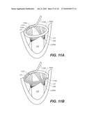 DIAGNOSTIC CATHETERS, GUIDE CATHETERS, VISUALIZATION DEVICES AND CHORD MANIPULATION DEVICES, AND RELATED KITS AND METHODS diagram and image