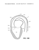 DIAGNOSTIC CATHETERS, GUIDE CATHETERS, VISUALIZATION DEVICES AND CHORD MANIPULATION DEVICES, AND RELATED KITS AND METHODS diagram and image