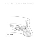 DIAGNOSTIC CATHETERS, GUIDE CATHETERS, VISUALIZATION DEVICES AND CHORD MANIPULATION DEVICES, AND RELATED KITS AND METHODS diagram and image