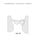 DIAGNOSTIC CATHETERS, GUIDE CATHETERS, VISUALIZATION DEVICES AND CHORD MANIPULATION DEVICES, AND RELATED KITS AND METHODS diagram and image