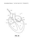 DIAGNOSTIC CATHETERS, GUIDE CATHETERS, VISUALIZATION DEVICES AND CHORD MANIPULATION DEVICES, AND RELATED KITS AND METHODS diagram and image