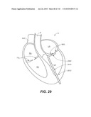 DIAGNOSTIC CATHETERS, GUIDE CATHETERS, VISUALIZATION DEVICES AND CHORD MANIPULATION DEVICES, AND RELATED KITS AND METHODS diagram and image