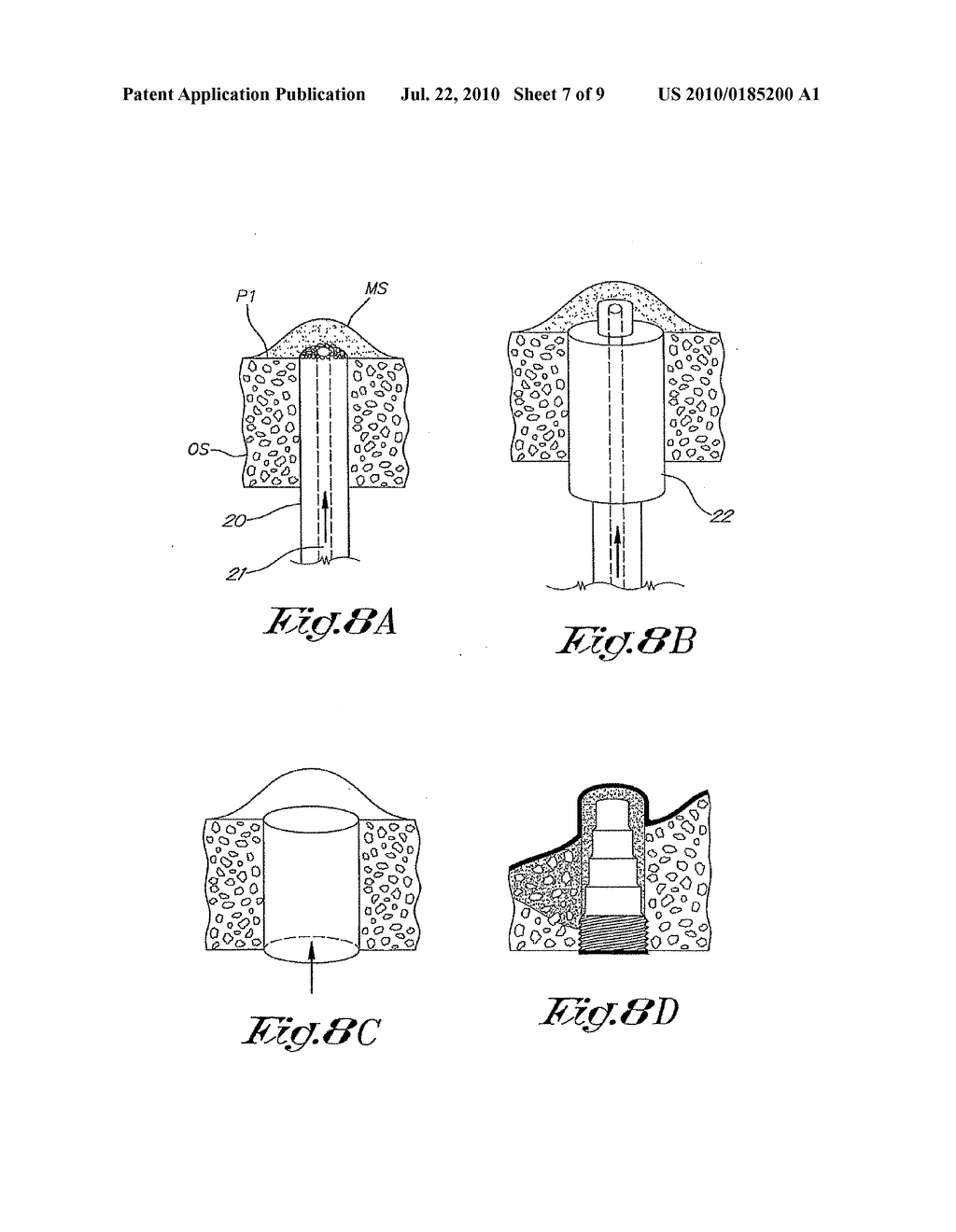 STRUCTURE FOR FORMING BONE - diagram, schematic, and image 08