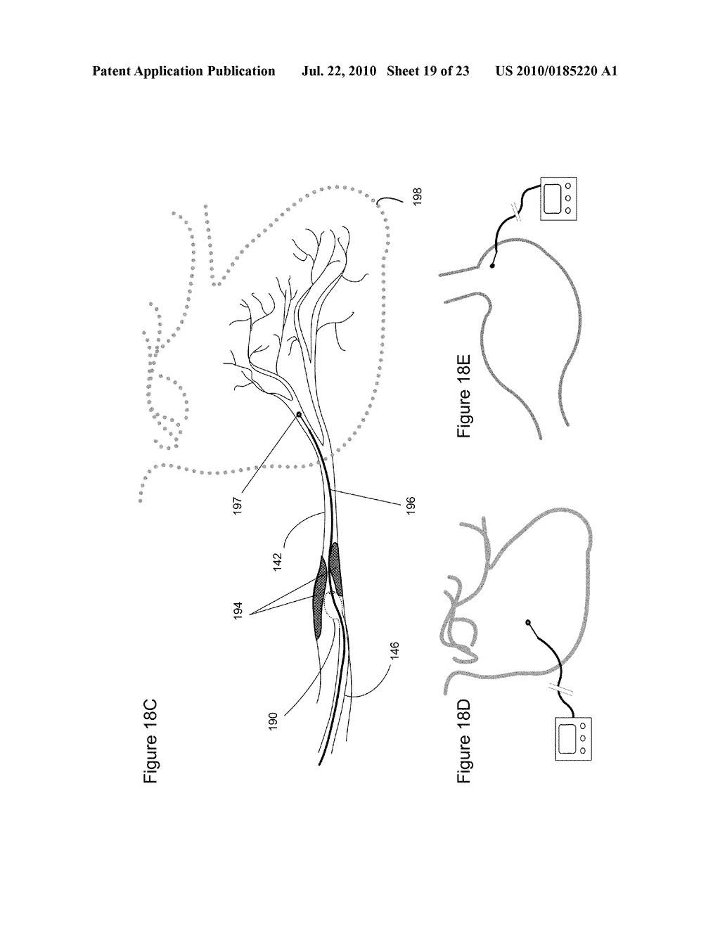 APPARATUS AND METHODS FOR CONTROLLED ISCHEMIC CONDITIONING - diagram, schematic, and image 20