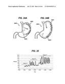 GUI FOR AN IMPLANTABLE DISTENSION DEVICE AND A DATA LOGGER diagram and image