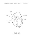 SYSTEMS AND METHODS FOR CLOSING AN APERTURE IN A BODILY TISSUE diagram and image