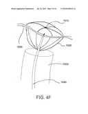 SYSTEMS AND METHODS FOR CLOSING AN APERTURE IN A BODILY TISSUE diagram and image