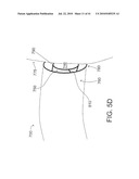 SYSTEMS AND METHODS FOR CLOSING AN APERTURE IN A BODILY TISSUE diagram and image