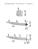 SYSTEMS AND METHODS FOR CLOSING AN APERTURE IN A BODILY TISSUE diagram and image