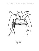 SYSTEMS AND METHODS FOR CLOSING AN APERTURE IN A BODILY TISSUE diagram and image