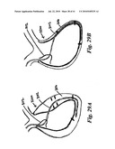 SYSTEMS AND METHODS FOR CLOSING AN APERTURE IN A BODILY TISSUE diagram and image