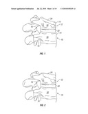 Devices and Methods for Treating Vertebral Fractures diagram and image