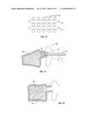 Devices and Methods for Treating Vertebral Fractures diagram and image