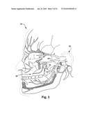 Surgical Guide and Method for Guiding a Therapy Delivery Device into the Pterygopalatine Fossa diagram and image