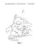 Surgical Guide and Method for Guiding a Therapy Delivery Device into the Pterygopalatine Fossa diagram and image