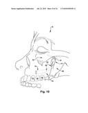 Surgical Guide and Method for Guiding a Therapy Delivery Device into the Pterygopalatine Fossa diagram and image