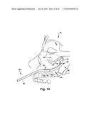 Surgical Guide and Method for Guiding a Therapy Delivery Device into the Pterygopalatine Fossa diagram and image