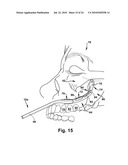 Surgical Guide and Method for Guiding a Therapy Delivery Device into the Pterygopalatine Fossa diagram and image