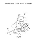 Surgical Guide and Method for Guiding a Therapy Delivery Device into the Pterygopalatine Fossa diagram and image