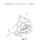 Surgical Guide and Method for Guiding a Therapy Delivery Device into the Pterygopalatine Fossa diagram and image