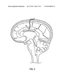 CORPUS CALLOSUM NEUROMODULATION ASSEMBLY diagram and image