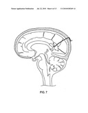 CORPUS CALLOSUM NEUROMODULATION ASSEMBLY diagram and image