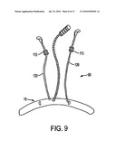 CORPUS CALLOSUM NEUROMODULATION ASSEMBLY diagram and image