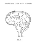 CORPUS CALLOSUM NEUROMODULATION ASSEMBLY diagram and image