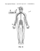 CORPUS CALLOSUM NEUROMODULATION ASSEMBLY diagram and image