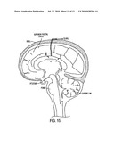 CORPUS CALLOSUM NEUROMODULATION ASSEMBLY diagram and image