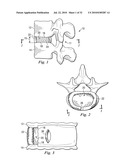 SPINAL NUCLEUS REPLACEMENT IMPLANTS diagram and image