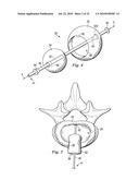 SPINAL NUCLEUS REPLACEMENT IMPLANTS diagram and image