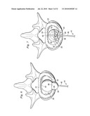 SPINAL NUCLEUS REPLACEMENT IMPLANTS diagram and image