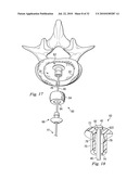 SPINAL NUCLEUS REPLACEMENT IMPLANTS diagram and image