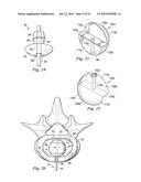 SPINAL NUCLEUS REPLACEMENT IMPLANTS diagram and image