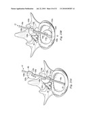 SPINAL NUCLEUS REPLACEMENT IMPLANTS diagram and image