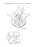 SPINAL NUCLEUS REPLACEMENT IMPLANTS diagram and image