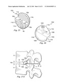 SPINAL NUCLEUS REPLACEMENT IMPLANTS diagram and image