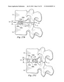 SPINAL NUCLEUS REPLACEMENT IMPLANTS diagram and image