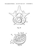 SPINAL NUCLEUS REPLACEMENT IMPLANTS diagram and image