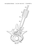 SPINAL NUCLEUS REPLACEMENT IMPLANTS diagram and image