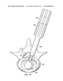 SPINAL NUCLEUS REPLACEMENT IMPLANTS diagram and image