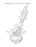 SPINAL NUCLEUS REPLACEMENT IMPLANTS diagram and image