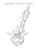 SPINAL NUCLEUS REPLACEMENT IMPLANTS diagram and image