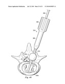 SPINAL NUCLEUS REPLACEMENT IMPLANTS diagram and image