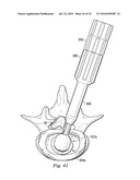 SPINAL NUCLEUS REPLACEMENT IMPLANTS diagram and image